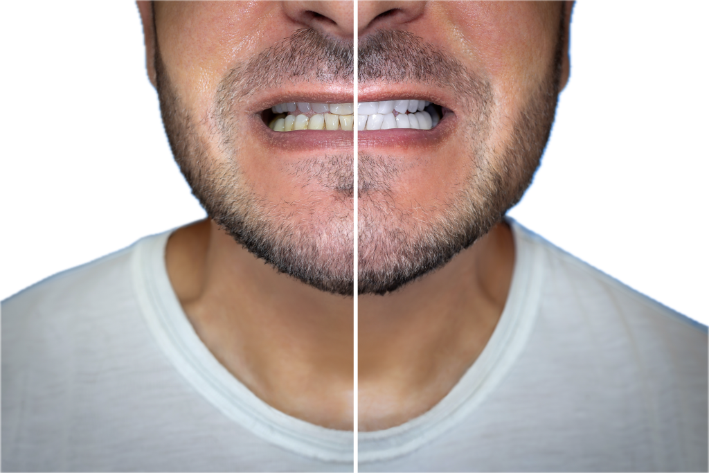 estética dental Don Benito, blanqueamiento dental Don Benito, carillas dentales Don Benito, sonrisa natural Don Benito.